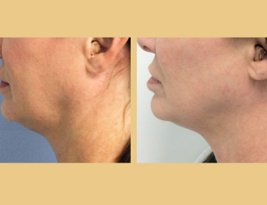 Skin-tightening-with-ultherapy